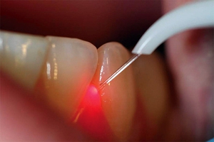 Лазерная имплантация зубов-описание