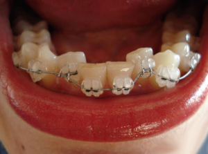 Самолигирующие брекеты выполняются из современных материалов и позволяют подходить индивидуально к каждому зубу