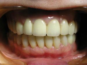 Преимущества и недостатки бюгельного протезирования зубов