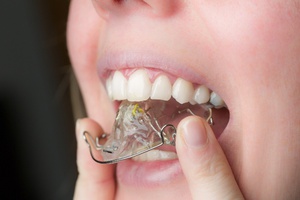 Как выравнить зубы без брекетов