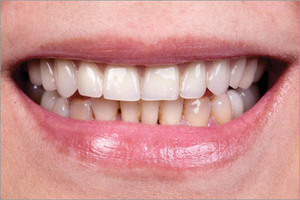 Описание аномалии неправильного прикуса зубов