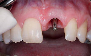 Описание метода одномоментной имплантации  зубов