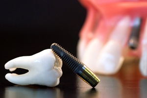 Показания к одномоментной имплантации зубов