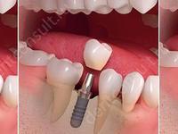 Установка импланта сразу после удаления зуба