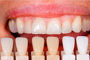 Как реставрировать зубы