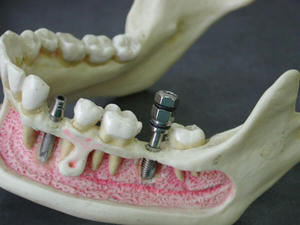 Какие есть варианты восстановления зубов