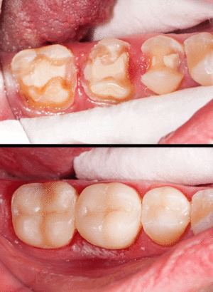 Способы наращивания зубов