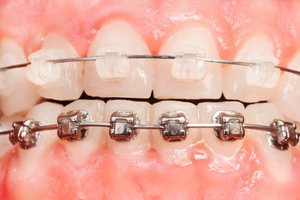 Как выравнивать зубы без брекетов