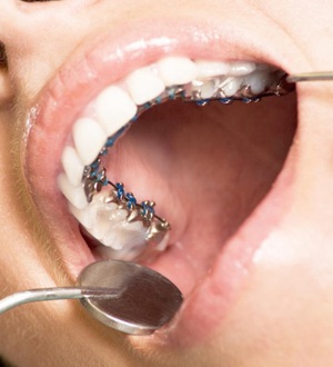 Несколько советов перед выравниванием зубов