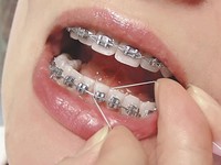 Инструкции для применения зубной нити при брекетах