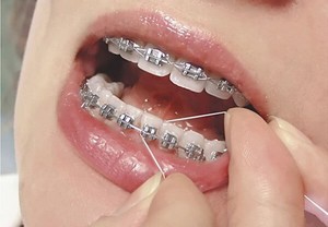 Инструкции для применения зубной нити при брекетах