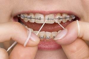 Описание процедуры применения зубной нити при брекетах
