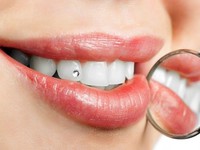 Скайсы на зубах: преимущества и недостатки