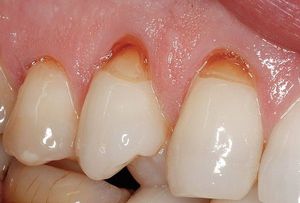 Причины возникновения клиновидного дефекта зубов