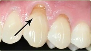 Симптомы клиновидного дефекта зубов у пациентов