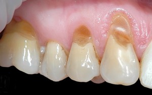 Лечения клиновидного дефекта зубов у взрослых