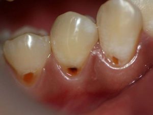 Меры по предупреждению клиновидного дефекта зубов у пациентов
