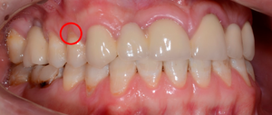 Осложнения клиновидного дефекта зубов у пациентов