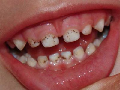 Черные полоски на зубах у ребенка