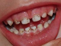Причины налета на зубах