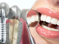 Имплантация зубов под ключ-описание