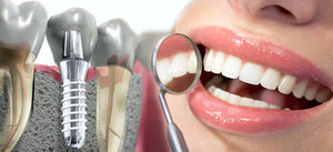 Имплантация зубов под ключ-описание