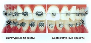 Разновидности зубных брекетов