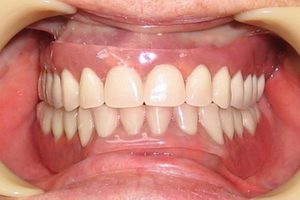 Описание зубных протезов из пластмассы