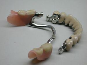 Характеристика бюгельных зубных протезов