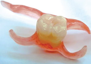 Особенности односторонних частично съёмных зубных протезов