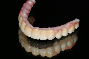 Способы имплантационного протезирования зубов