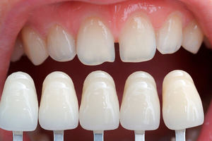 Описание несъёмного протезирования зубов