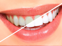 Как отбелить зубы перекисью водорода в домашних условиях