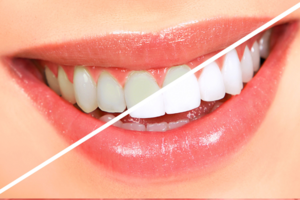 Как отбелить зубы перекисью водорода в домашних условиях