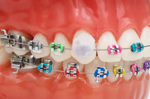 Виды стоматологического воска