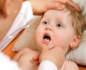 Симптом, по которому можно определить молочницу – белый налет во рту у грудничка 