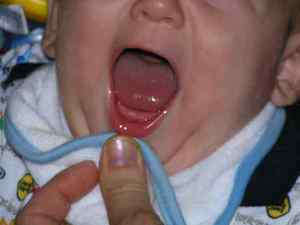 Прорезаются зубки у ребенка
