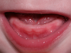 Симптомами прорезывания зубов являются слюноотделение и набухание десен