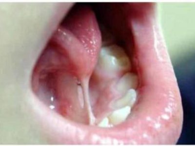 Подрезание уздечки под языком у детей: возраст, методы