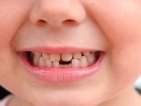 Сколько может быть молочных зубов