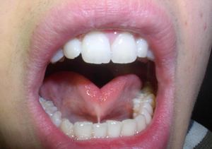 Причины гингивита у детей-аномалии уздечки языка