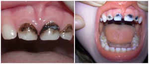 Зубы после процедуры серебрения