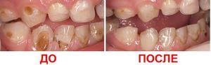 Лечение и серебрение зубов