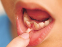 Как удалить молочный зуб у ребенка