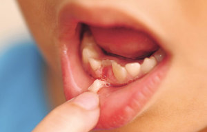 Как удалить молочный зуб у ребенка
