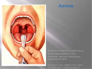 Как лечить заболевания горла