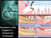 Как ухаживать за полостью рта после удаления зуба