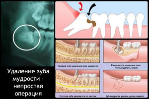 Как ухаживать за полостью рта после удаления зуба