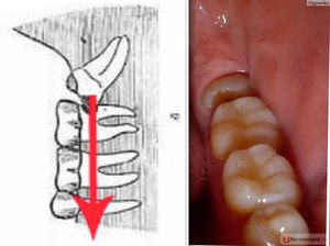 Как проводится процедура удаления зуба мудрости