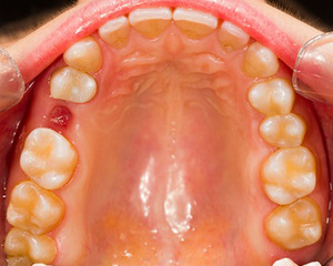 Чем унять боль в десне после удаления зуба
